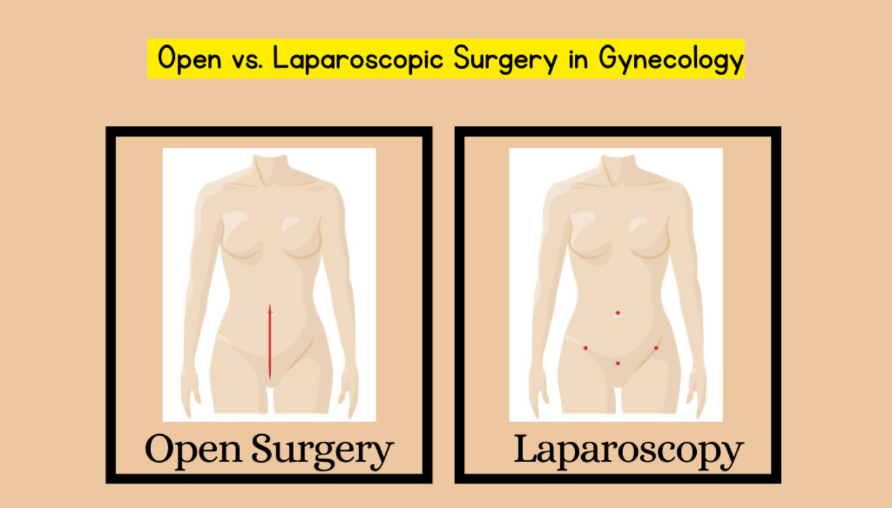 choosing-the-right-path-open-vs-laparoscopic-surgery-in-gynecology